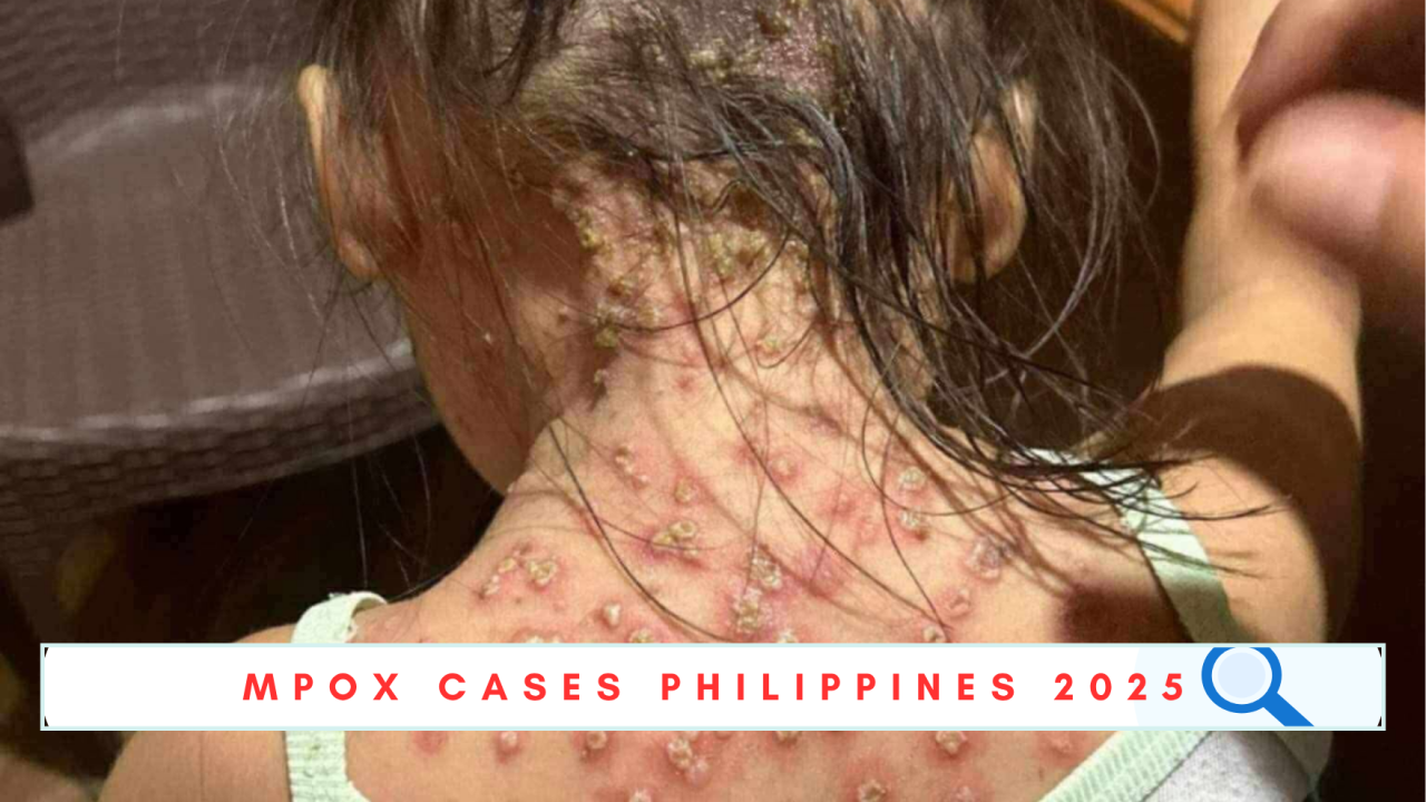 mpox cases philippines 2025