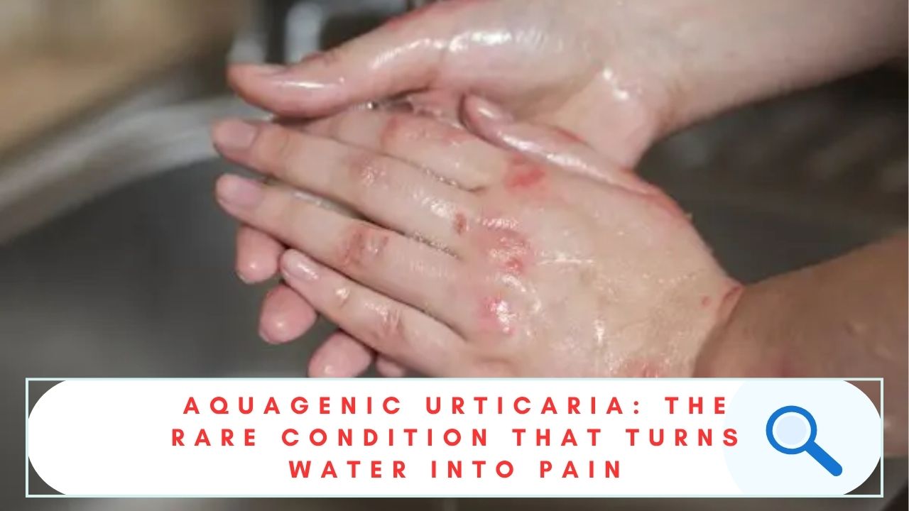 AQUAGENIC URTICARIA