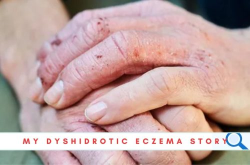 Dyshidrotic Eczema